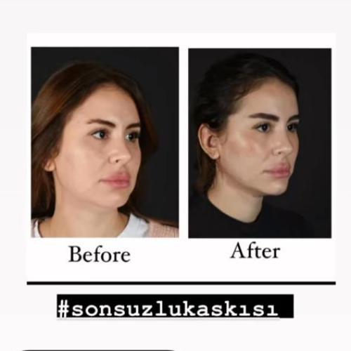 подтяжка лица паутиной Фотографии до и после